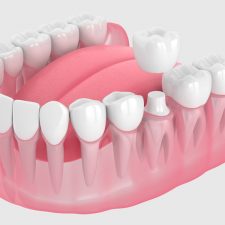 What to Expect Throughout a Dental Crown Procedure?