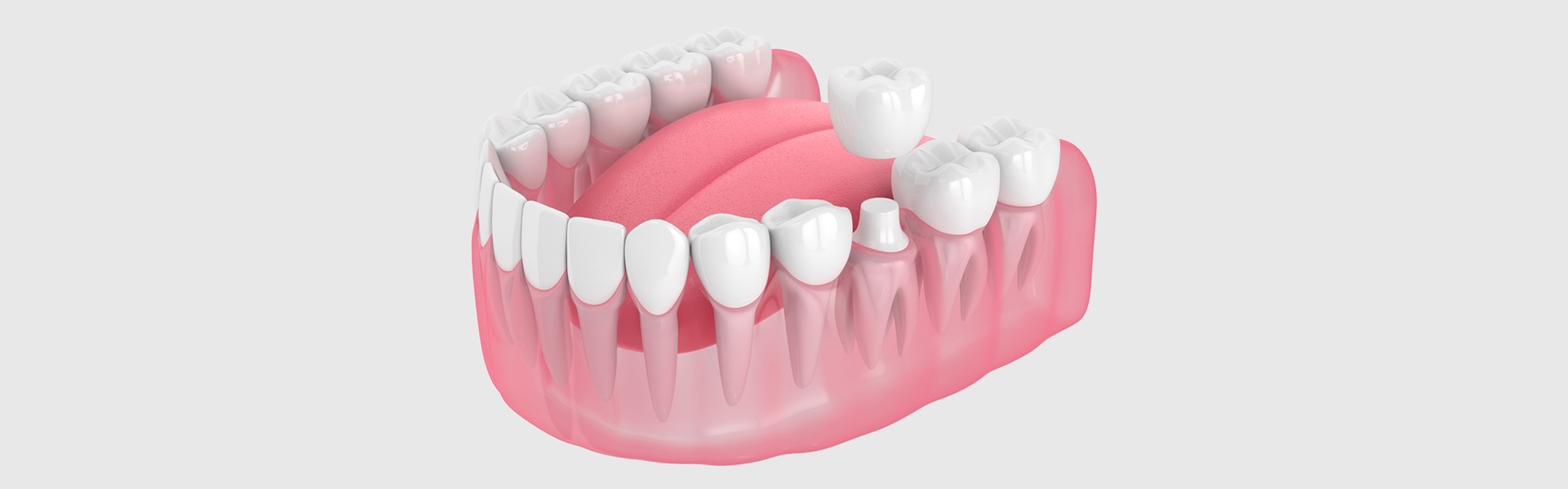 What to Expect Throughout a Dental Crown Procedure?