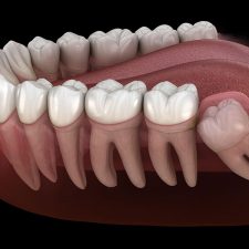 Wisdom Teeth Removal: Anticipating the Experience Prior, During, and Following?