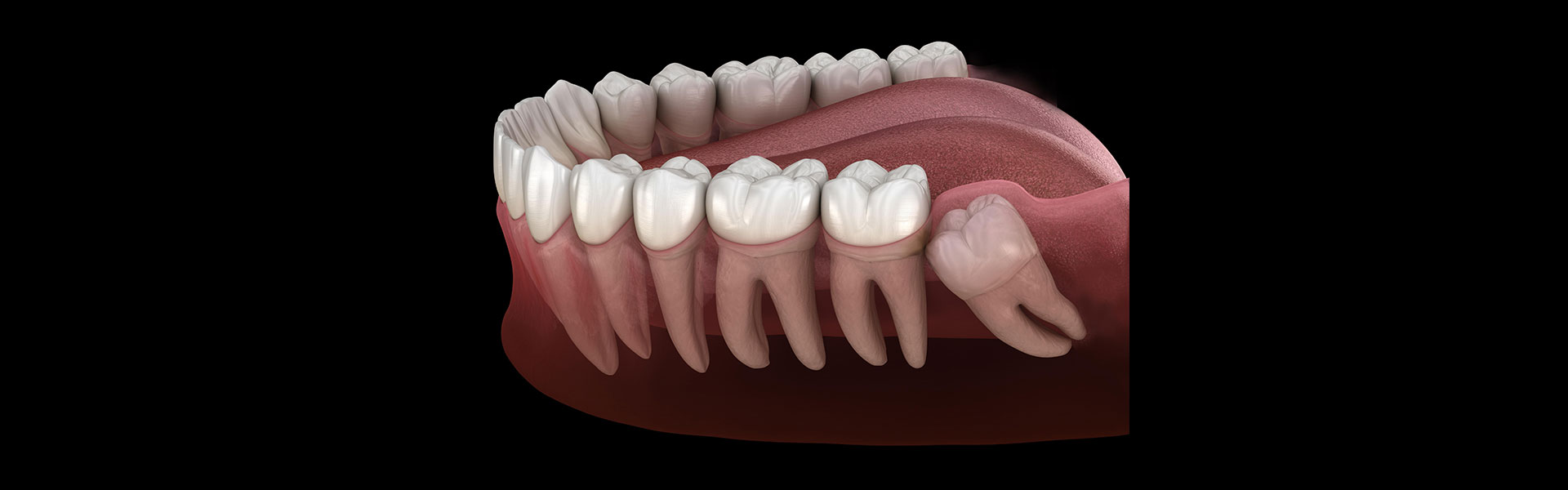Wisdom Teeth Removal: Anticipating the Experience Prior, During, and Following?