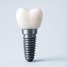 Why Dental Implants Are a Smart Investment
