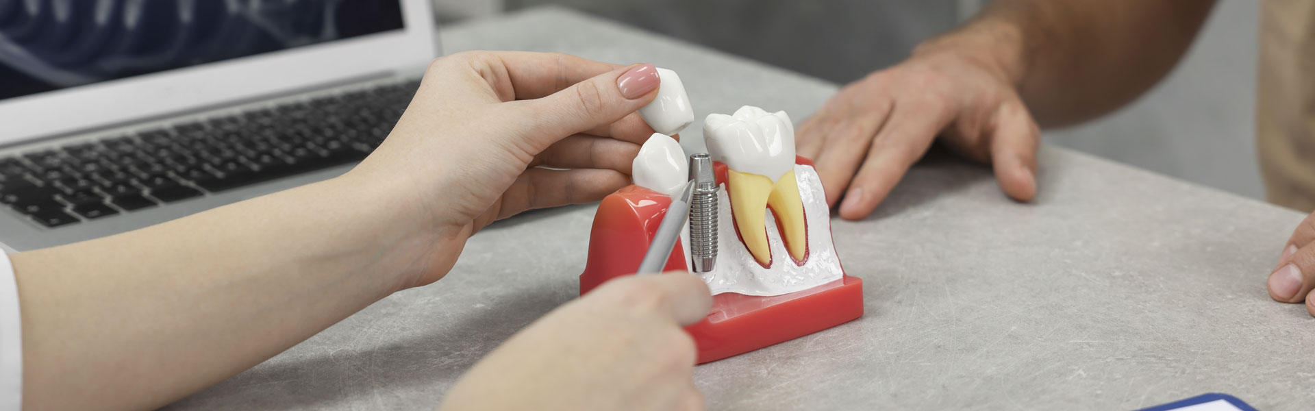 How Implants Help You Smile with Confidence