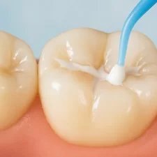 Dental Sealants in Central Northwest Houston: Myths