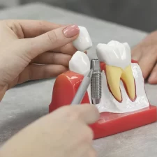 What Are The Dental Implants Steps?